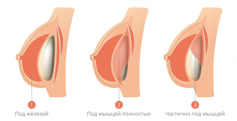 infographics plastika grudi