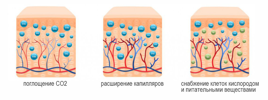 karboksiterapia