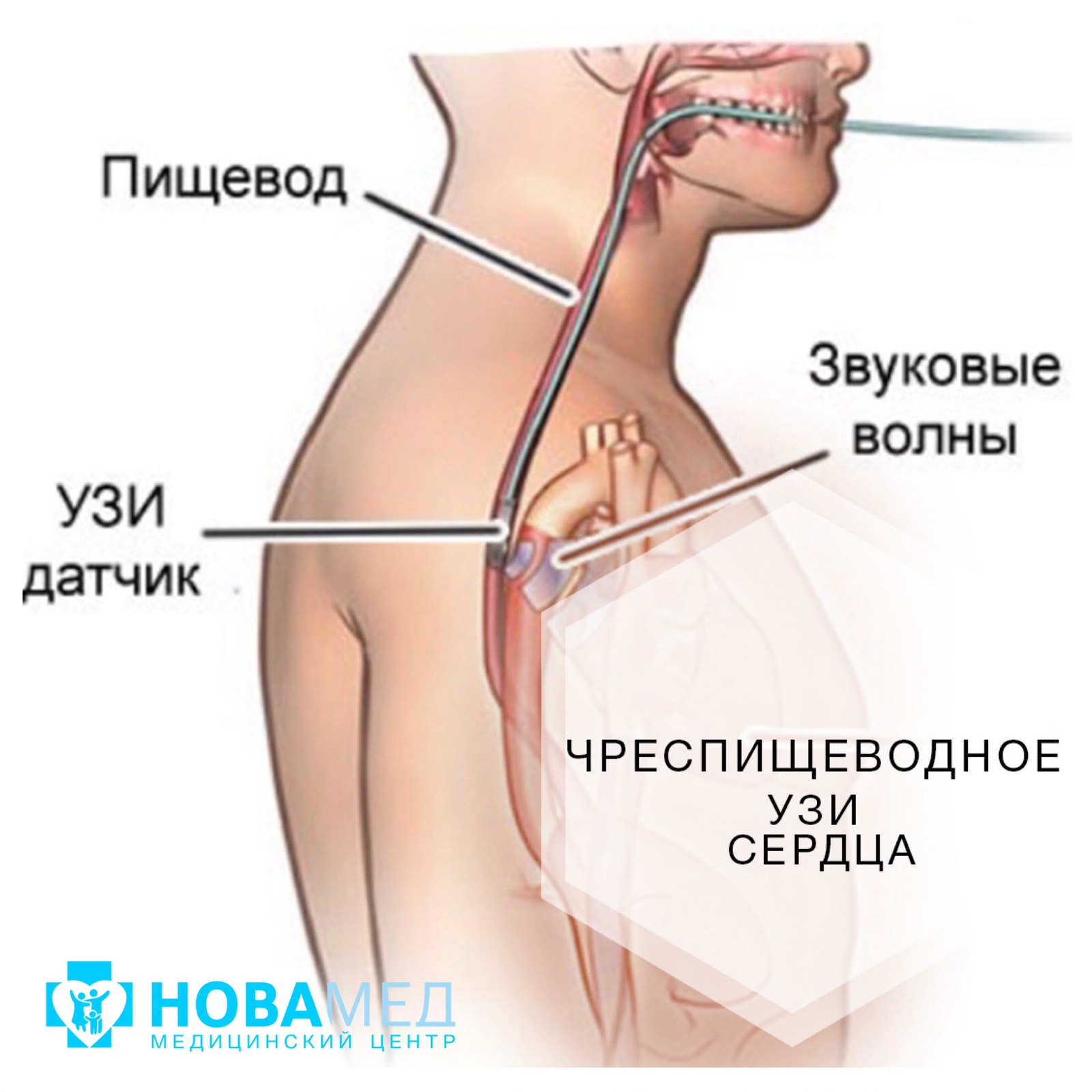 Чреспищеводное УЗИ сердца в «НОВАМЕД»